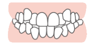ガタガタした歯並び八重歯