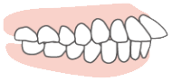 出っ歯（上顎前突）