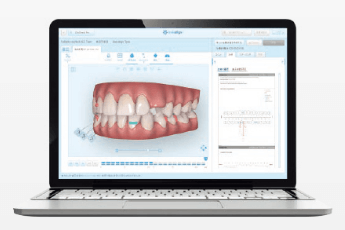 事前に矯正治療後のシミュレーションができる！